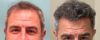 State of the Art Hair Restoration for Men & Women including ultra refined hair transplantation, FUE hair transplant techniques & Extracellular Vesicles, Hair Regrowth Therapy.